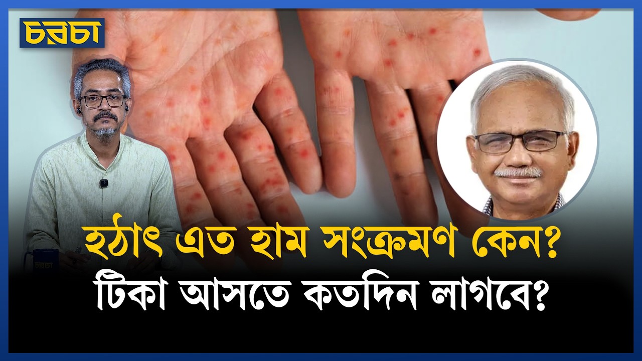 হাম সংক্রমণ মোকাবিলায় এই মুহূর্তে ৩টি কাজ করা খুবই জরুরি: ডা. মুশতাক হোসেন