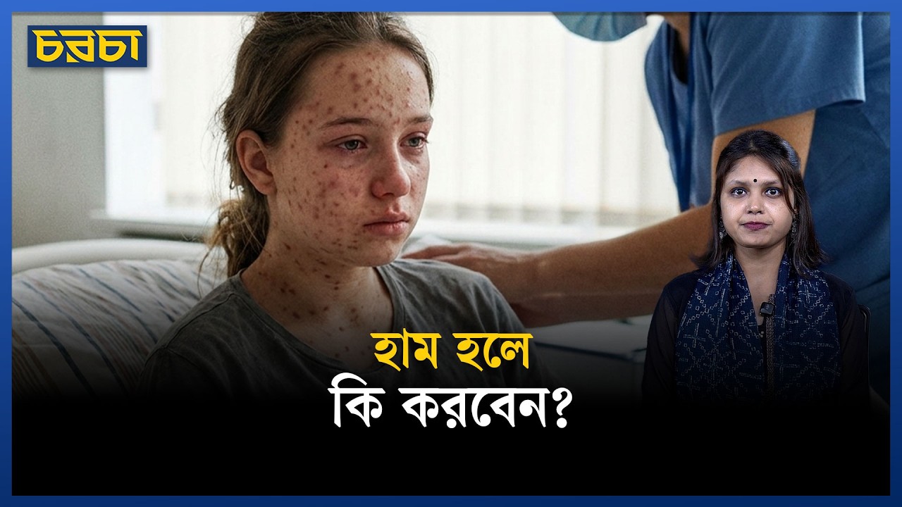 কীভাবে বুঝবেন হাম হয়েছে?
