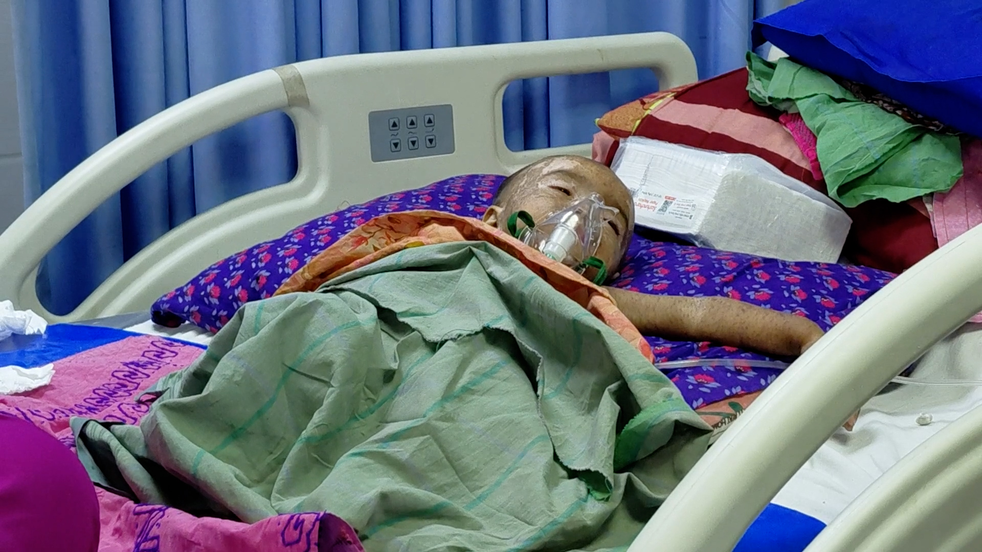 হামের উপসর্গে আরও ৫ শিশুর মৃত্যু, প্রাণহানি বেড়ে ৮৭৮ 
