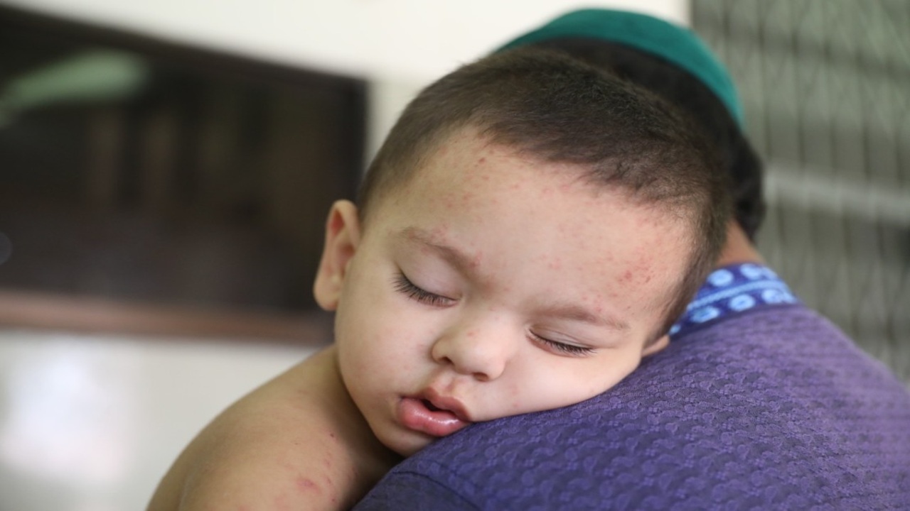 হাম উপসর্গে ২৪ ঘণ্টায় ১১ জনের মৃত্যু, আক্রান্ত বেশি ঢাকায়